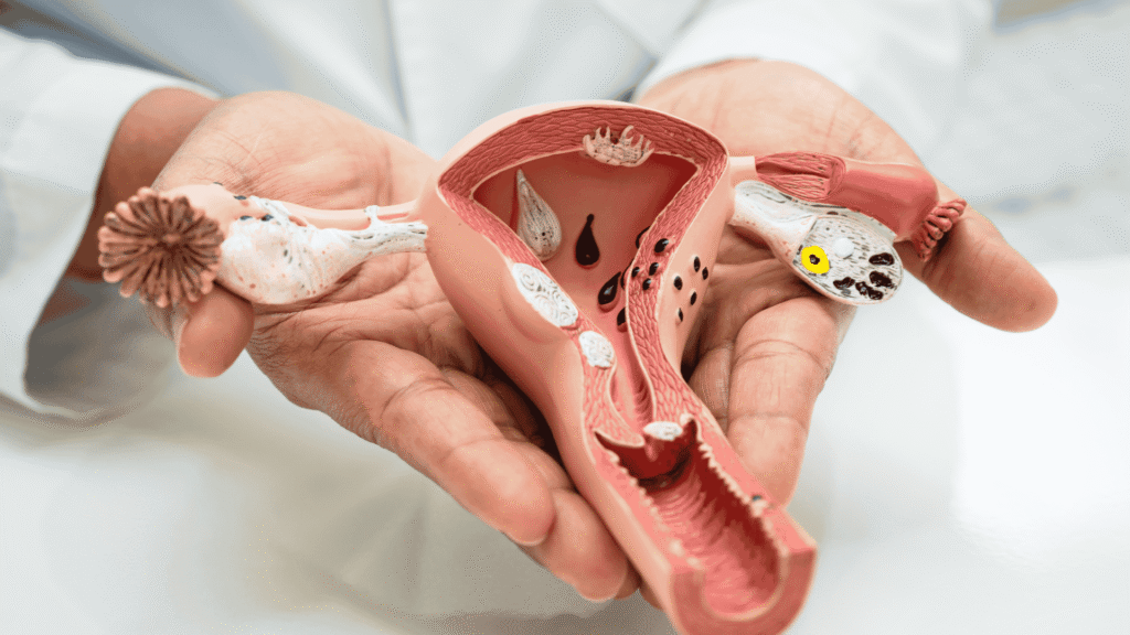 Síndrome dos Ovários Policísticos (SOP) | Dra. Nadine Ziegler | Ginecologia e Reprodução Assistida